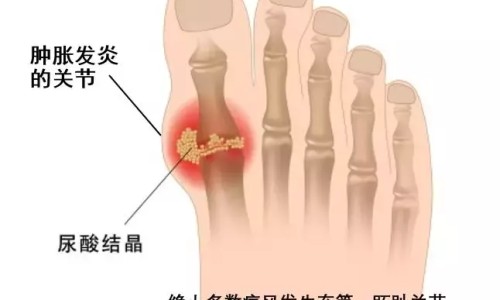 肿瘤病人放疗后主要黏膜反应是-放疗后黏膜变硬怎么办专区_肿瘤病人放疗是怎么治疗专区_肿瘤病人放疗后主要黏膜反应网